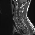 Normal cervical spine MRI (Radiopaedia 38418-40496 Sagittal T1 5).jpg