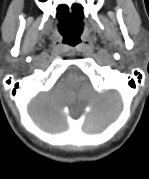 File:Normal cervical spine MRI (including Dixon) (Radiopaedia 42762-45926 Axial non-contrast 7).png