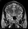 Normal coronal brain (Radiopaedia 6676-7910 Coronal T2 12).jpg