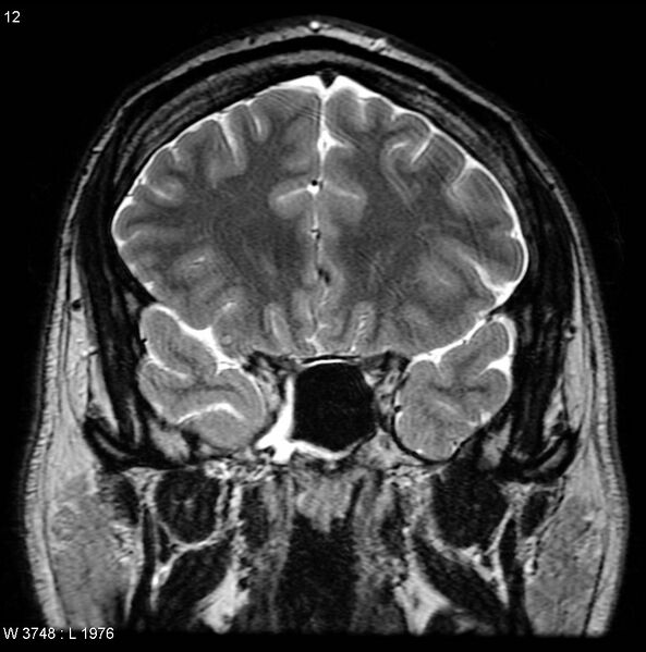 File:Normal coronal brain (Radiopaedia 6676-7910 Coronal T2 12).jpg