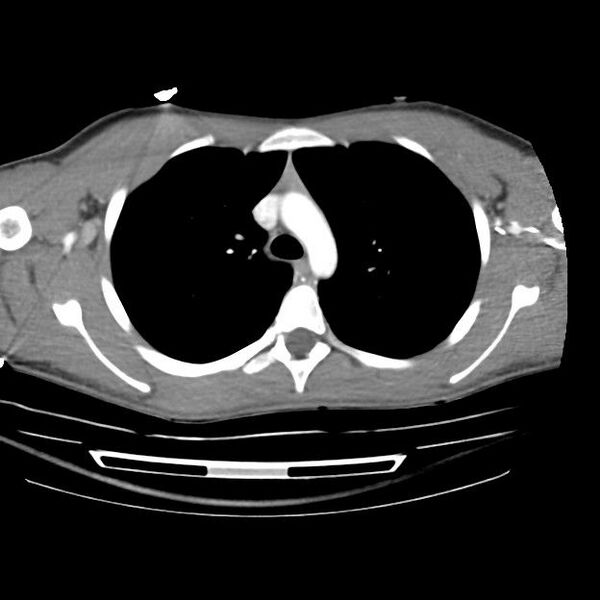 File:Normal dual-phase trauma CT chest,abdomen and pelvis (Radiopaedia 48092-52899 A 17).jpg