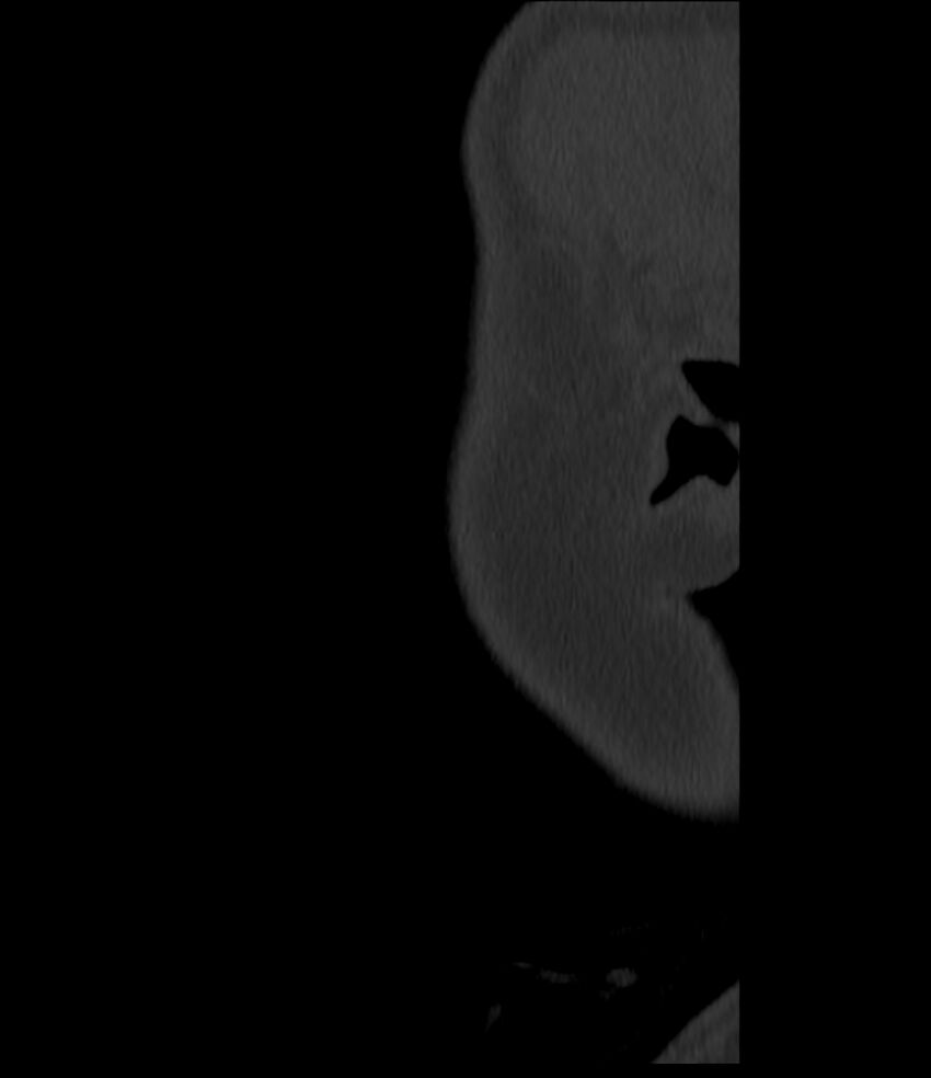 Normal facial bone CT (Radiopaedia 88742-105476 Sagittal bone window 162).jpg