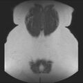 Normal liver MRI with Gadolinium (Radiopaedia 58913-66163 Coronal T2 39).jpg