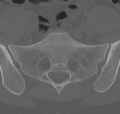 Normal lumbar spine CT (Radiopaedia 46533-50986 Axial bone window 71).png