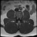 Normal lumbar spine MRI (Radiopaedia 35543-37039 Axial T1 24).png