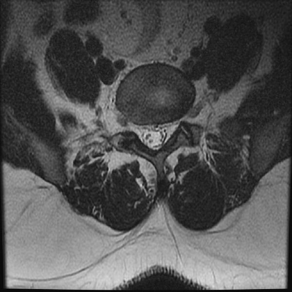 File:Normal lumbar spine MRI (Radiopaedia 43051-46311 Axial T2 22).jpg