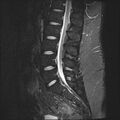 Normal lumbar spine MRI (Radiopaedia 47857-52609 Sagittal STIR 10).jpg