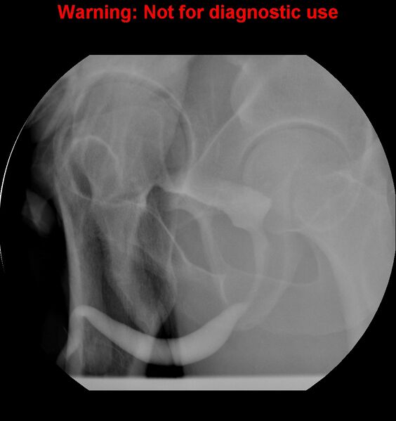 File:Normal retrograde urethrogram (RUG) and voiding cystourethrogram (VCUG) (Radiopaedia 40478-43050 VCUG 9).jpg