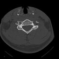 Occipital condyle fracture (Radiopaedia 31755-32691 Axial bone window 49).jpg