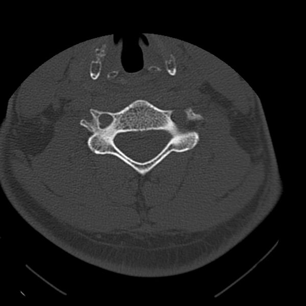 File:Occipital condyle fracture (Radiopaedia 31755-32691 Axial bone window 49).jpg
