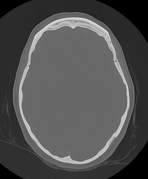 File:Occipital condyle fracture (Radiopaedia 61165-69056 Axial bone window 12).jpg