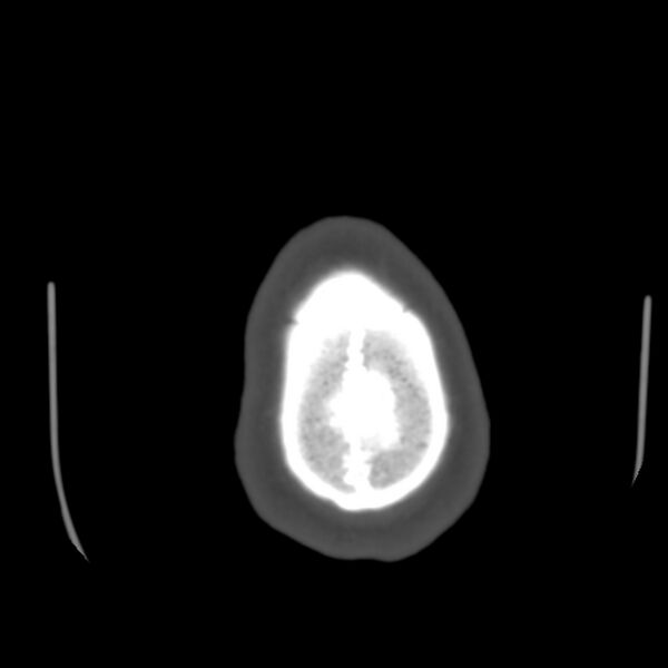 File:Occipital spur - asymptomatic (Radiopaedia 87753-104201 Axial bone window 209).jpg
