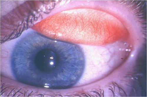 Seasonal and perennial allergic conjunctivitis: mild conjunctival injection and moderate chemosis.