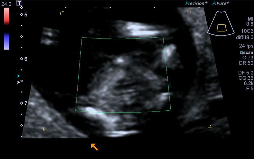 1st trimester nuchal-morphology ultrasound (Radiopaedia 44706-48477 Heart views cine with colour 157).jpg