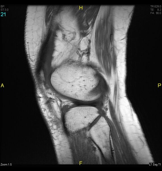 File:ACL mucoid degeration with cystic changes (Radiopaedia 48428-53341 Sagittal T1 19).jpg
