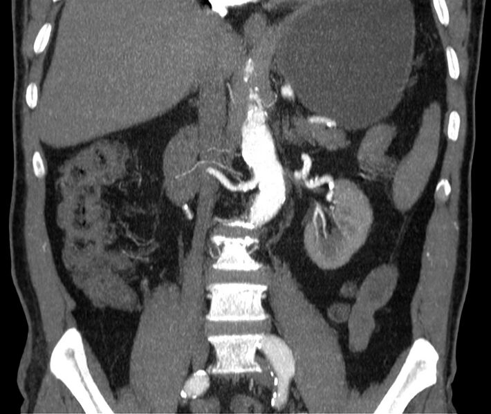 File:Abdominal aortic aneurysm (Radiopaedia 22421-22458 C 23).jpg