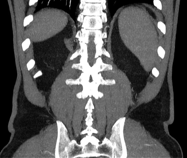 File:Abdominal aortic aneurysm (Radiopaedia 22421-22458 C 40).jpg