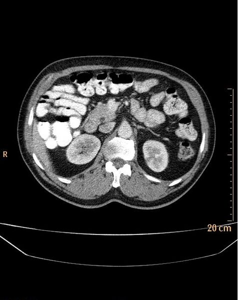 File:Abdominal aortic aneurysm (Radiopaedia 25985-26121 Axial C+ arterial phase 5).jpg