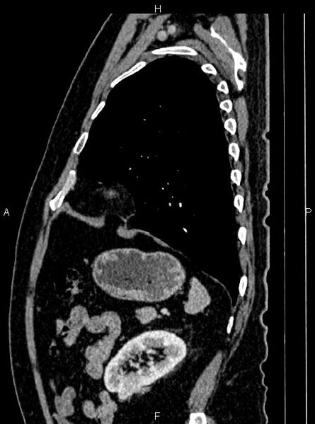 File:Abdominal aortic aneurysm (Radiopaedia 83094-97462 Sagittal renal cortical phase 95).jpg