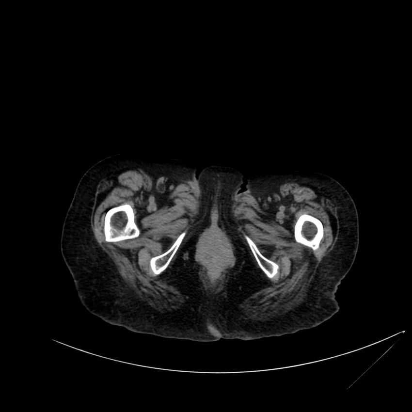 Abdominal aortic aneurysm - impending rupture (Radiopaedia 19233-19246 Axial non-contrast 138).jpg