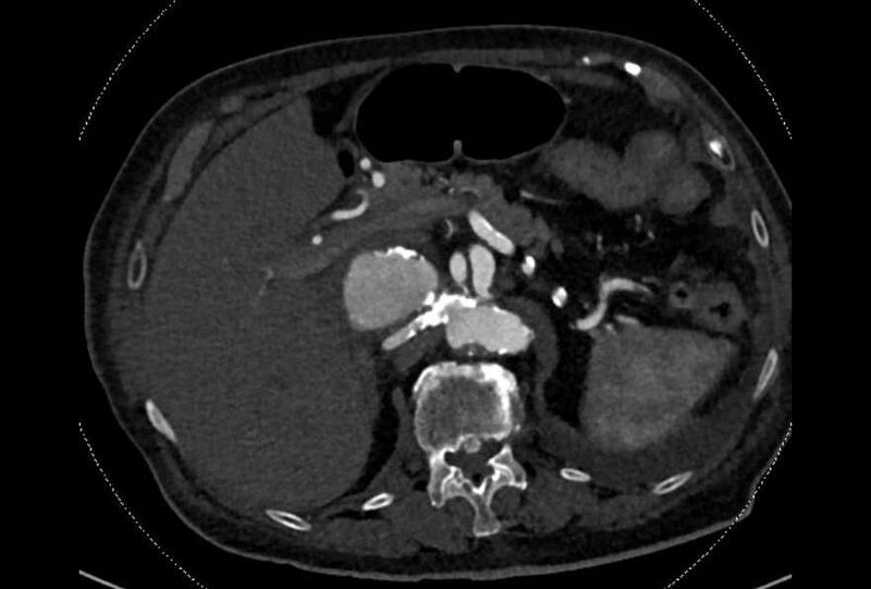 File:Abdominal aortic aneurysm with thrombus fissuration (Radiopaedia 73192-83919 Axial C+ arterial phase 33).jpg