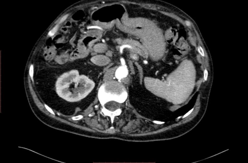 File:Abdominal aortic interposition tube graft and aneurysm thrombosis (Radiopaedia 71438-81857 Axial C+ arterial phase 23).jpg