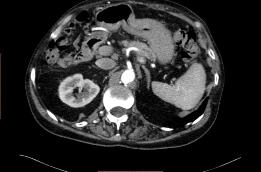 Abdominal aortic interposition tube graft and aneurysm thrombosis (Radiopaedia 71438-81857 Axial C+ arterial phase 23).jpg
