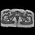 Abdominal wall endometriosis (Radiopaedia 83702-98847 Axial T1 18).jpg