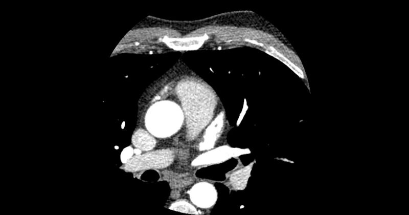 File:Aberrant left main coronary artery (ALMCA) arising from the right sinus with interarterial course (Radiopaedia 63251-71814 Axial C+ arterial phase 38).JPG