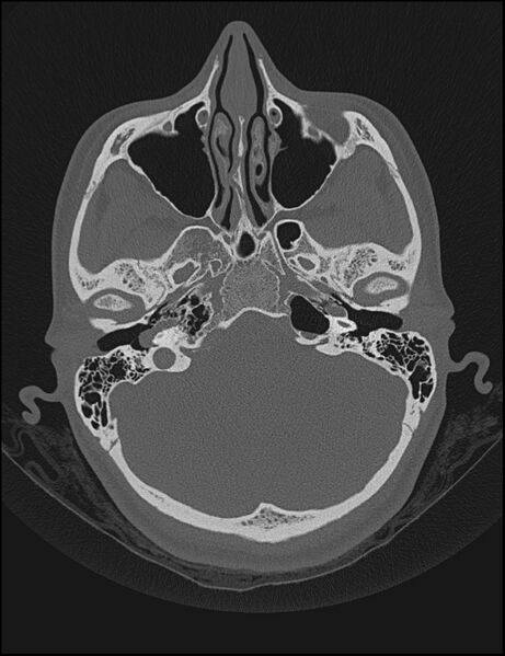 File:Aberrant right internal carotid artery (Radiopaedia 65191-74198 Axial non-contrast 37).jpg