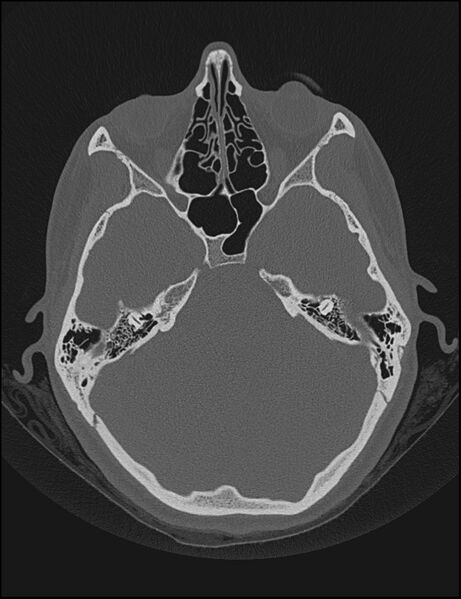 File:Aberrant right internal carotid artery (Radiopaedia 65191-74198 Axial non-contrast 56).jpg