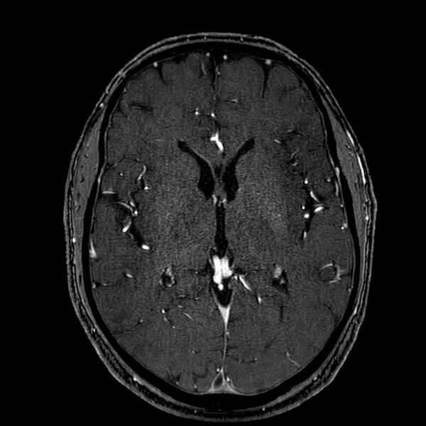 File:Accessory middle cerebral artery (Radiopaedia 73114-83828 Axial MRA 106).jpg