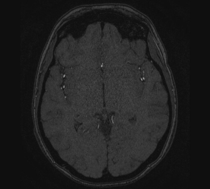 Accessory middle cerebral artery and ICA aneurysm (Radiopaedia 22656-22674 MRA 71).jpg