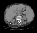 Accessory spleen (Radiopaedia 11156-41303 Axial non-contrast 1).jpg