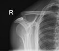 Acromioclavicular joint injury - Rockwood III (Radiopaedia 60196-67799 B 1).jpg