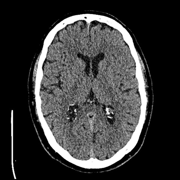 File:Acute A3 occlusion with ACA ischemic penumbra (CT perfusion) (Radiopaedia 72036-82525 Axial non-contrast thins 39).jpg