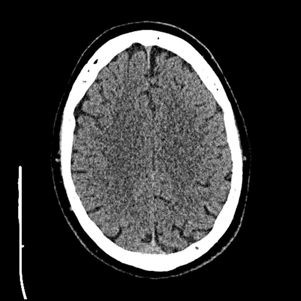 File:Acute A3 occlusion with ACA ischemic penumbra (CT perfusion) (Radiopaedia 72036-82525 Axial non-contrast thins 76).jpg