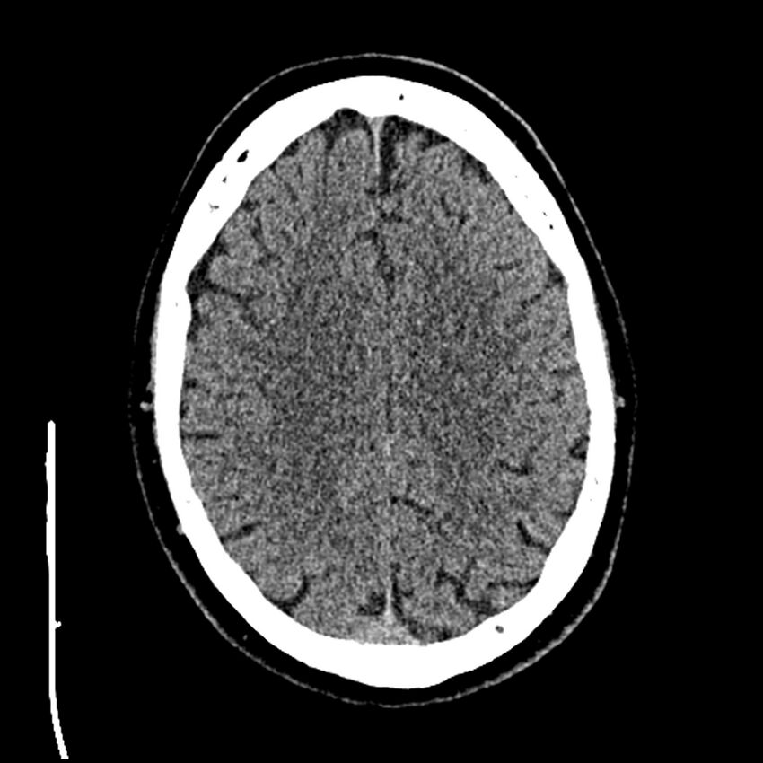 Acute A3 occlusion with ACA ischemic penumbra (CT perfusion) (Radiopaedia 72036-82525 Axial non-contrast thins 76).jpg