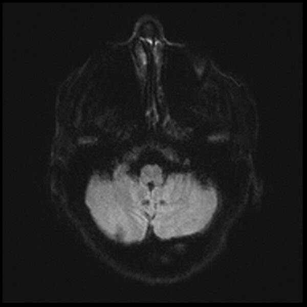 File:Acute P1 occlusion with PCA ischemia penumbra (CT perfusion) (Radiopaedia 72084-82590 Axial DWI 6).jpg