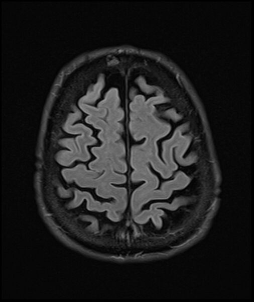 File:Acute P1 occlusion with PCA ischemia penumbra (CT perfusion) (Radiopaedia 72084-82590 Axial FLAIR 32).jpg