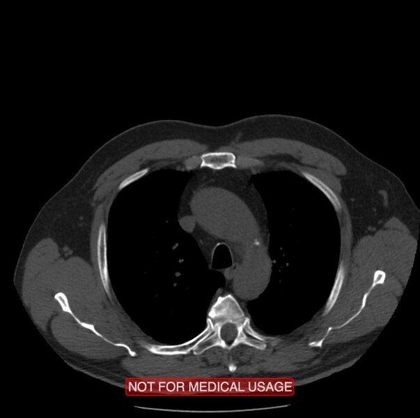 File:Acute aortic dissection - Stanford type A (Radiopaedia 40661-43285 Axial non-contrast 7).jpg