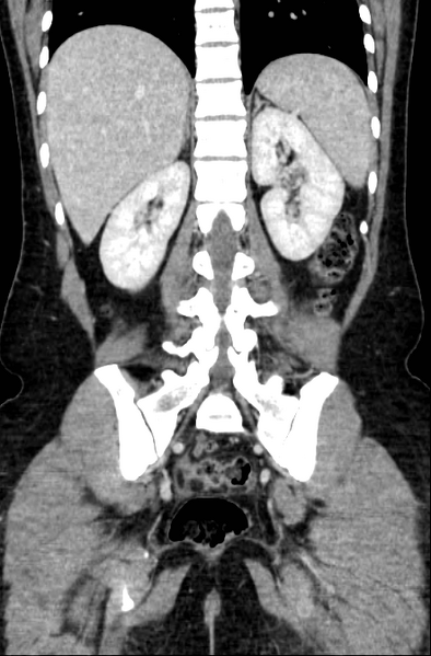 File:Acute appendicitis (Radiopaedia 22892-22918 Coronal C+ portal venous phase 40).png