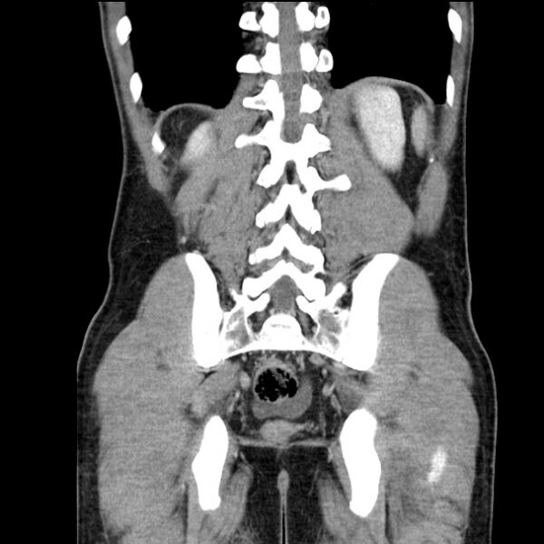 File:Acute appendicitis (Radiopaedia 27049-27227 Coronal C+ portal venous phase 45).jpg