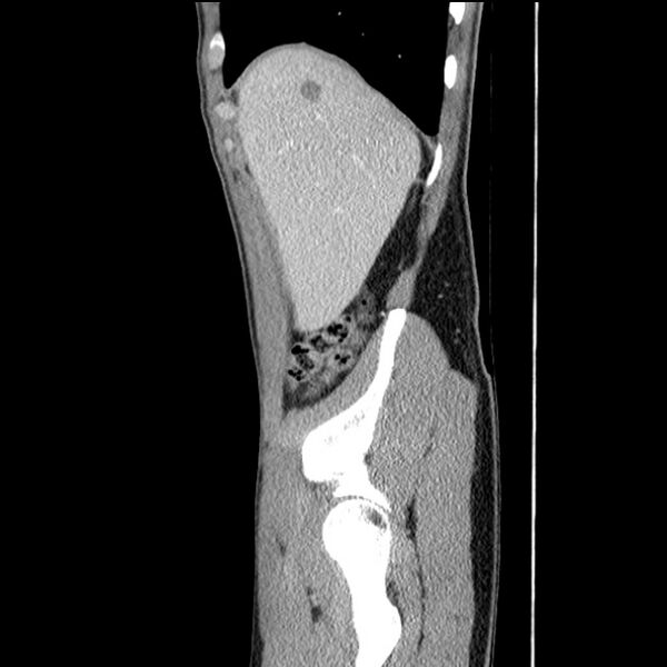 File:Acute appendicitis (Radiopaedia 27049-27227 Sagittal C+ portal venous phase 12).jpg