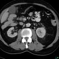 Acute appendicitis arising from a malrotated cecum (Radiopaedia 19970-19997 Axial C+ portal venous phase 10).jpg