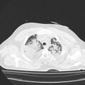 Acute aspiration pneumonitis (Radiopaedia 33605-34703 Axial lung window 23).jpg