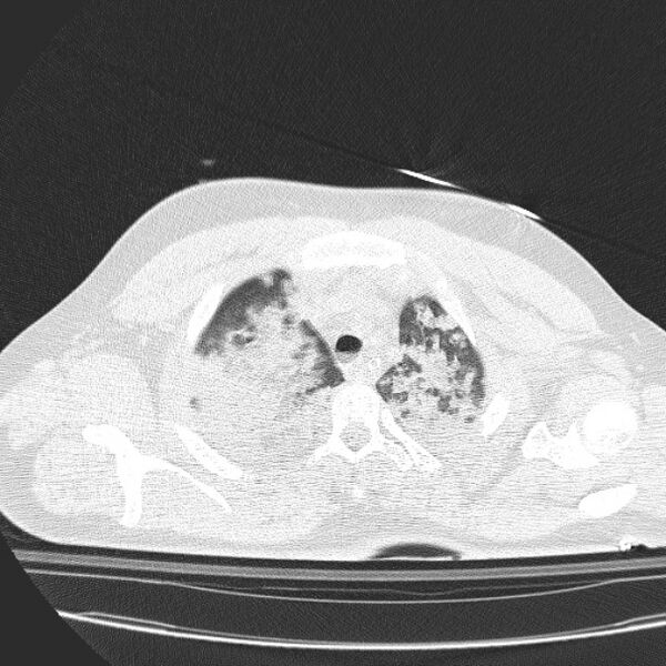 File:Acute aspiration pneumonitis (Radiopaedia 33605-34703 Axial lung window 23).jpg