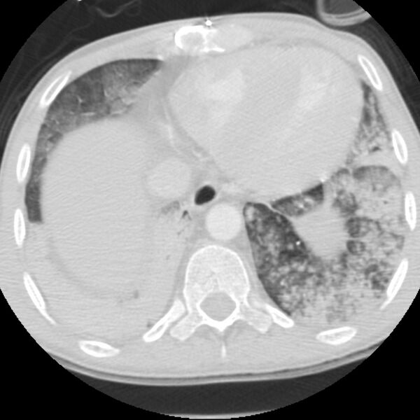 File:Acute diffuse alveolar hemorrhage (Radiopaedia 41323-44158 Axial lung window 51).jpg