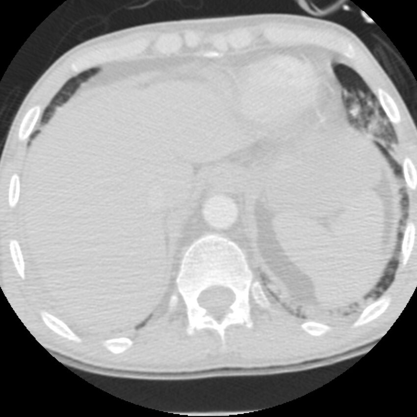 Acute diffuse alveolar hemorrhage (Radiopaedia 41323-44158 Axial lung window 57).jpg
