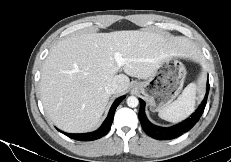File:Acute diverticulitis - Hinchey stage Ia (Radiopaedia 82071-96095 Axial C+ arterial phase 1).jpg